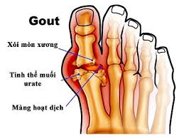 Đông y trị bệnh gout (gút)
