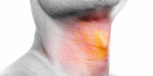5 nguyên nhân phổ biến nhất gây ung thư họng