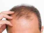Bệnh nấm da đầu - Nguyên nhân và cách điều trị