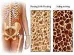 Bệnh loãng xương và cách điều trị hiệu quả