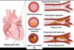 Cách phòng ngừa nhồi máu cơ tim cấp, tránh nguy cơ ngừng tim