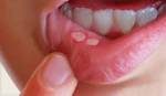 Bài thuốc trị chứng lở miệng ( nhiệt miệng - Vị nhiệt)